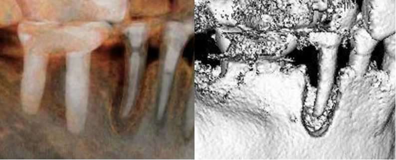 根管治療歯は寿命があります・・・成功率？数年～20年後に必ず抜歯に至ります？