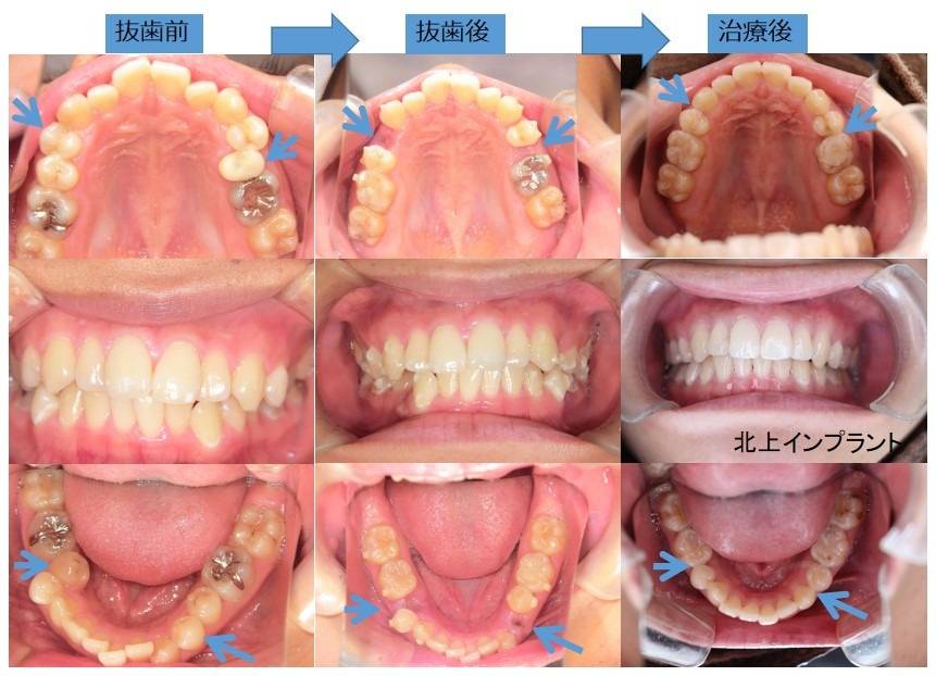 歯科矯正における抜歯ガイドライン