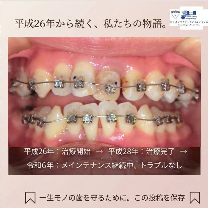 10年後も「再発なし」の笑顔へ。矯正×精密むし歯治療で手に入れる、一生モノの審美と健康。