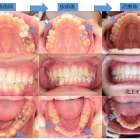 歯科矯正における抜歯ガイドライン