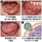 ただの口内炎？それともウイルス感染？